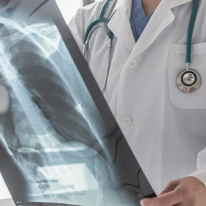 A picture of a doctor holding a chest x-ray